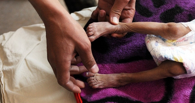 İHH İnsani Yardım Vakfı Genel Başkanı Yıldırım: Yemen'de çocuklar bir deri bir kemik kalmış durumda
